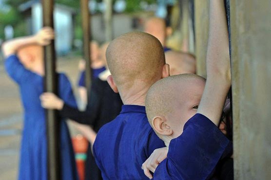 Potions and polls: Tanzanian albinos terrified after attacks