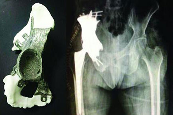Italian teen gets titanium pelvis in world first