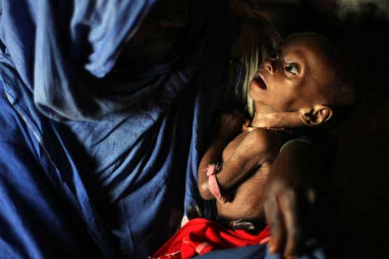 Malnutrition brings a terrible disease to children in Niger