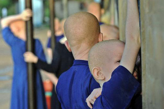 UN rights chief denounces surge in albino attacks