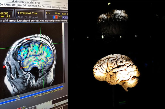 Brain implant senses 'intent' to move robotic arm