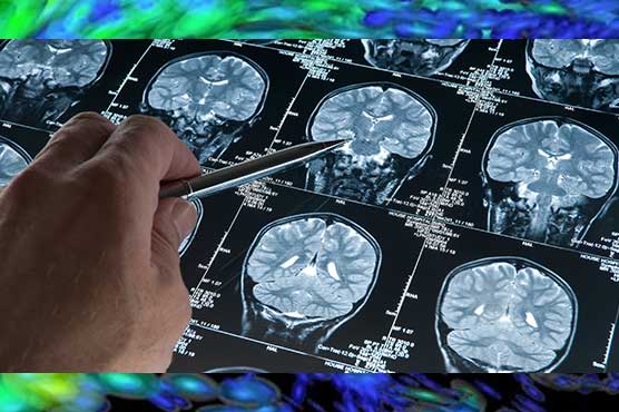 Brain research gets $100 million boost 