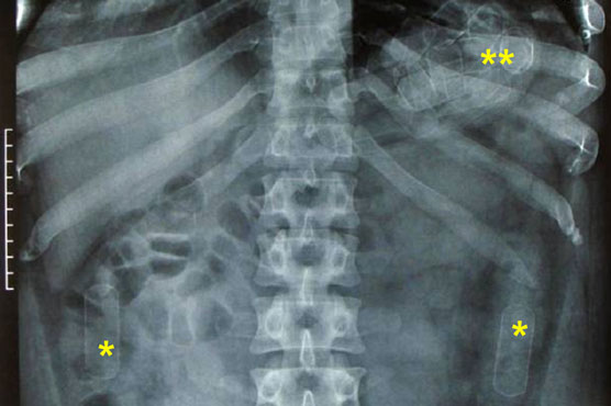 Colombian family arrested with 3 kg of drugs in stomachs 