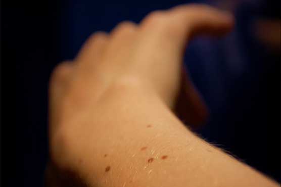 Arm mole count could indicate skin cancer risk: study