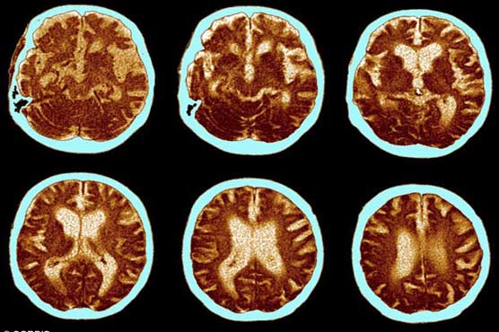 Injections may have passed on Alzheimer's 'seeds': study 