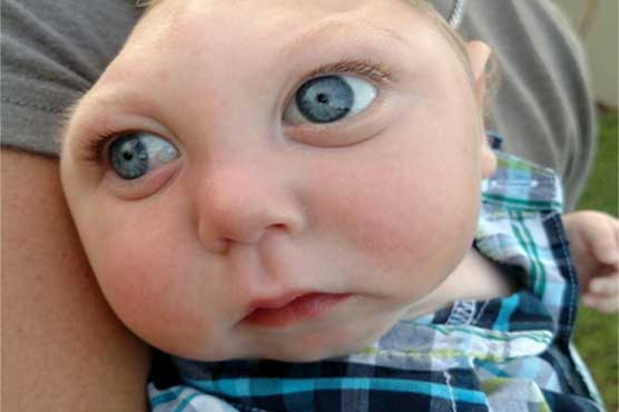 Baby born with half of his head missing defies odds
