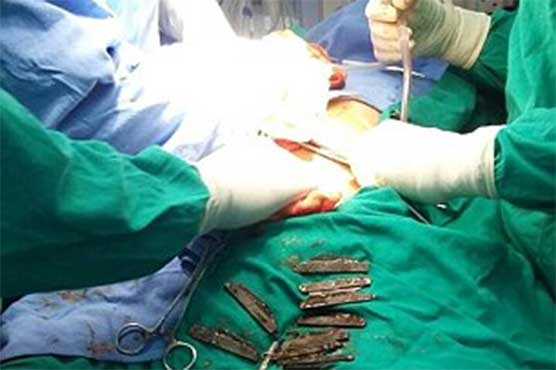 Indian man blames 'spiritual powers' for swallowing 40 knives