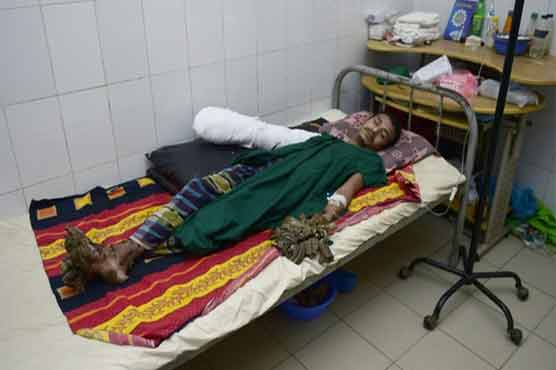 Bangladesh's 'Tree Man' may need dozen more operations