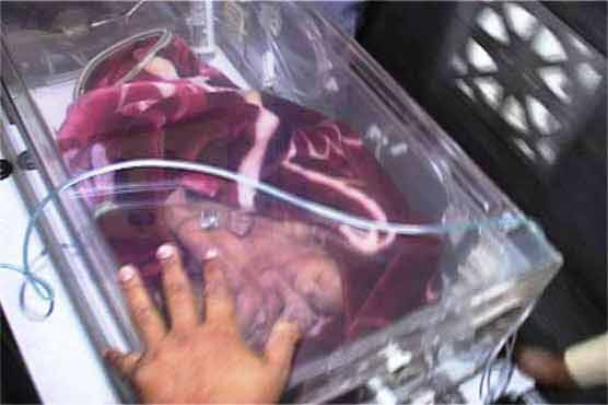 Multan: conjoined girls get ill, again shifted to hospital