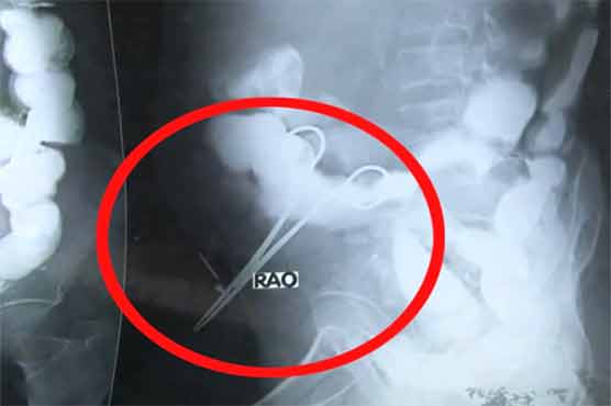 Doctor leaves scissors in stomach, demands 50,000 for re-operation