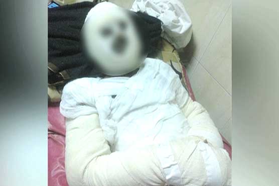 Islamabad: 18 year old set on fire by brother-in-law