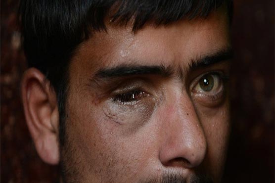 More than 300 pellet hit Kashmiris can lose their sight, says doctors