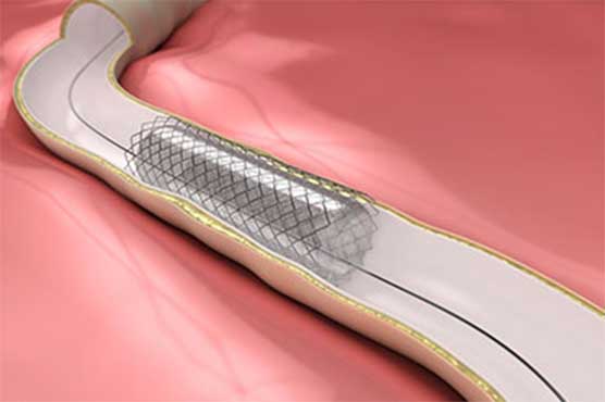 Two suspects out on bail in illegal stents matter