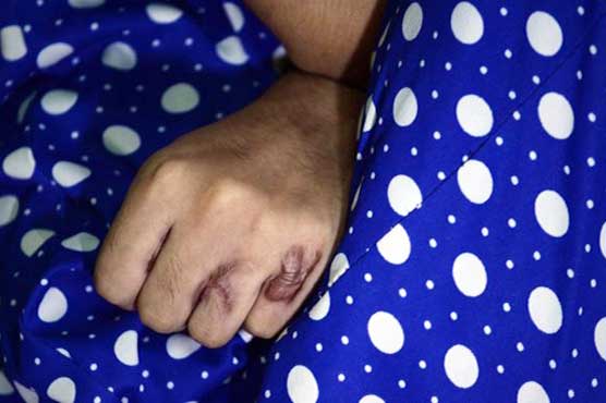Indian woman attacked with acid for fifth time: police