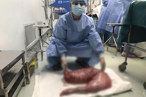 Surgeons remove 30 inches of Chinese man's large intestines
