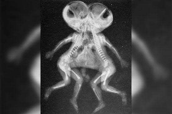 Conjoined twin sisters born in West Bank share one heart