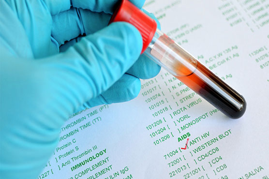 World lags badly on targets to slash TB, HIV, obesity: study