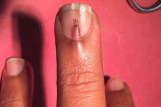 Man baffles doctors with small nail growing on top of his middle finger's nail