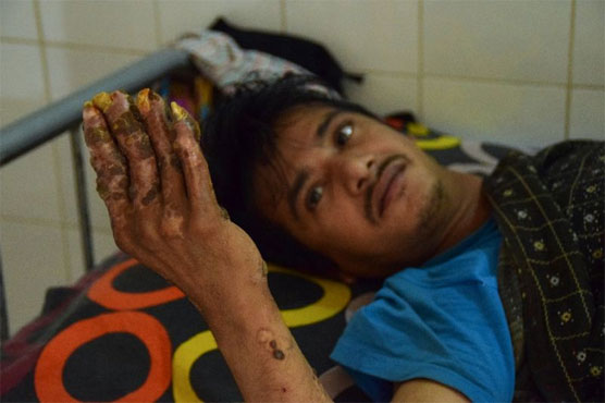 After 24 surgeries, Bangladesh 'tree man' relapses