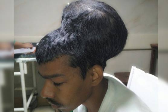 'Heaviest recorded' brain tumour removed from 31-year-old man