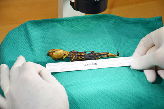 Tiny Atacama skeleton was girl with bone disease: study