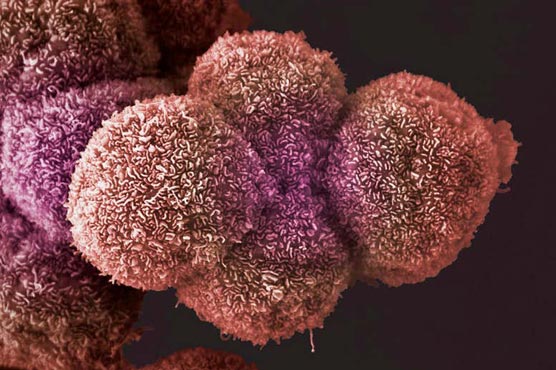 First map of tumour microbiomes finds bacteria live in many cancers