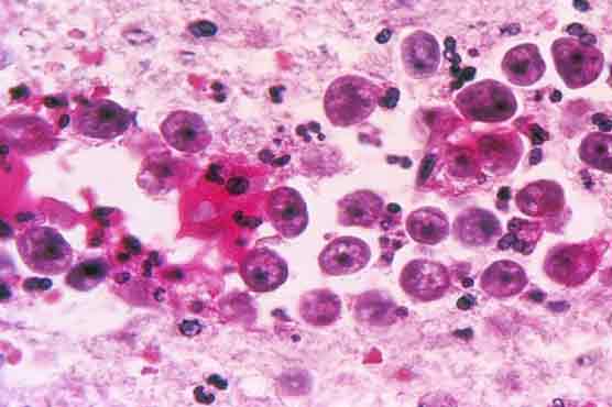 Naegleria claims two lives in Karachi, toll rises to four