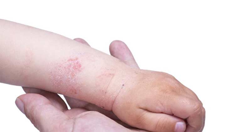 Eczema: New drug reduces symptoms by 75% in infants and young children