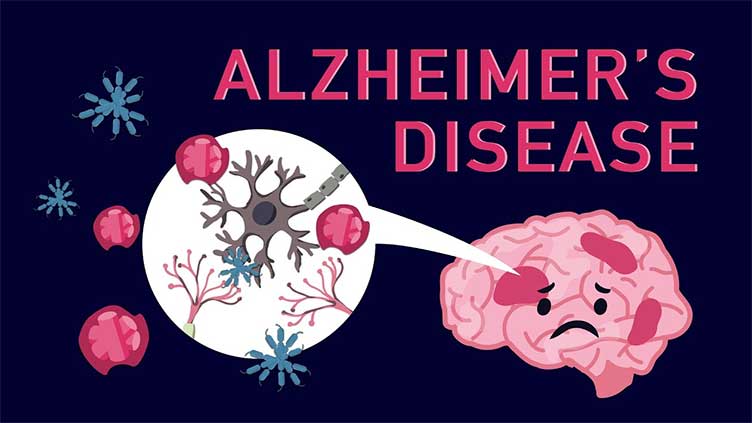 Light and sound to reduce Alzheimer disease, new research