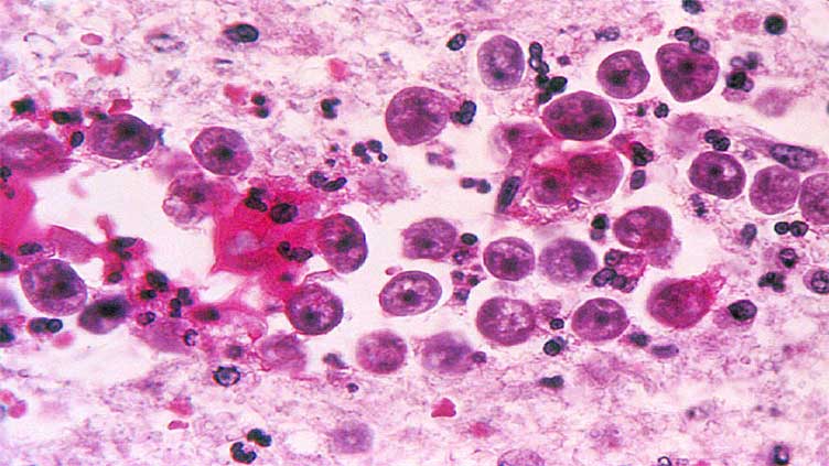 Naegleria claims another life in Karachi, toll rises to three