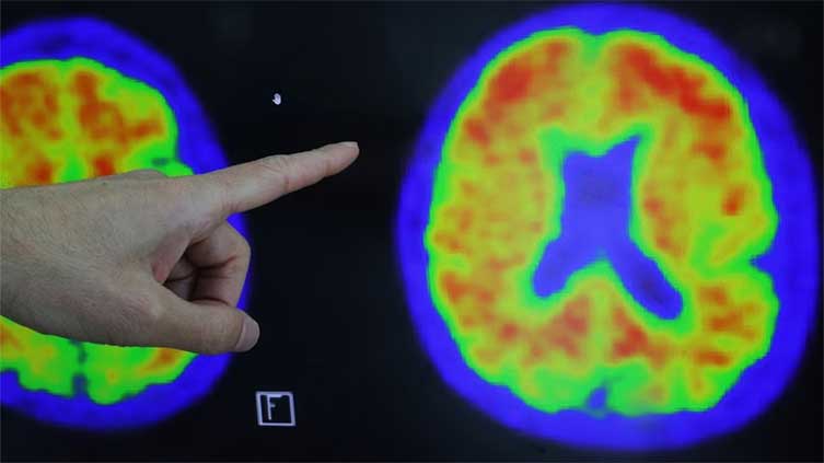 US to build $300 mln database to fuel Alzheimer's research
