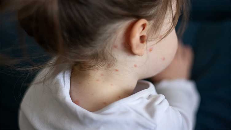 Measles cases spiking across the world: WHO