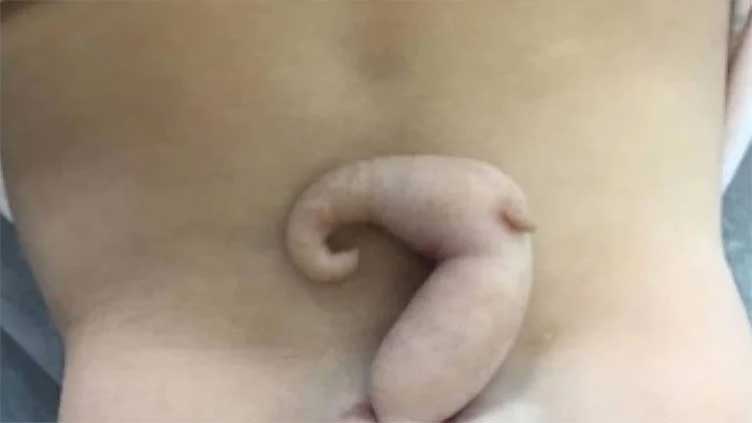 Baby girl born with six-centimeter tail in Brazil