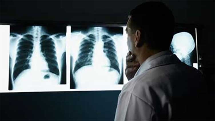 Geographical barriers removed by a new donor lung allocation method