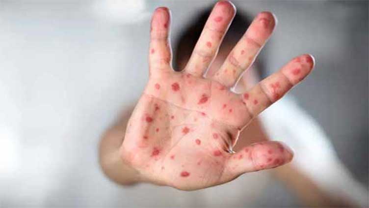 Diphtheria, measles responsible for many deaths in Punjab