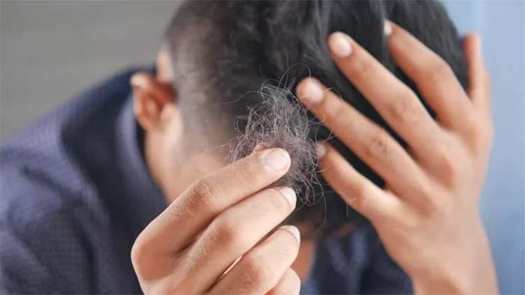 Drinking sugary beverages linked to hair loss in men