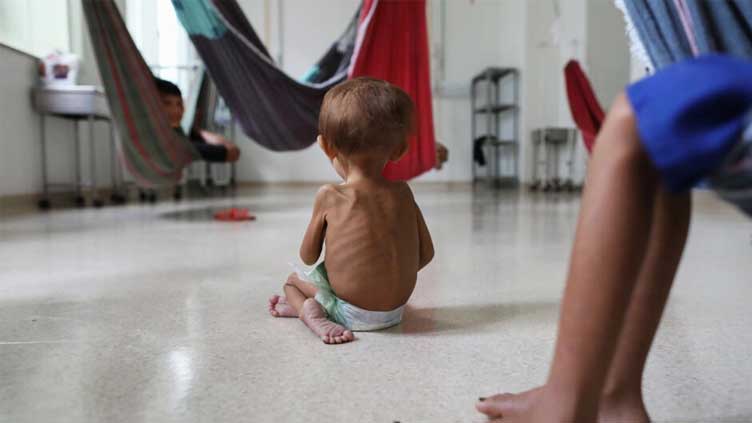  In Brazil's Amazon, malnourished Yanomami children get needed care