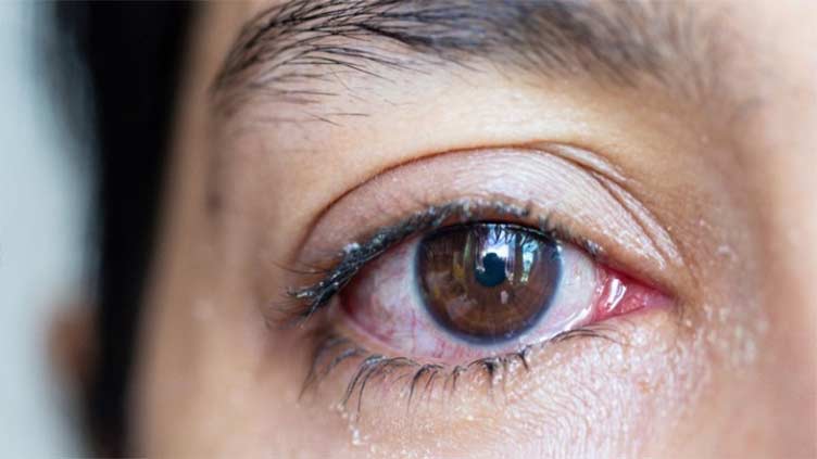 Myths and facts: Dry eye disease