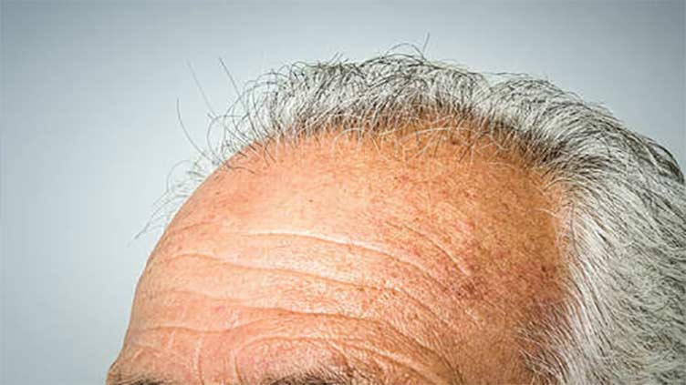 Baldness breakthrough? microRNA may stimulate growth in aging hair follicles