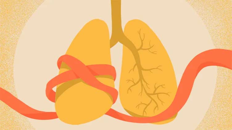 Asthma and COPD medication albuterol is in short supply: What you can do about it