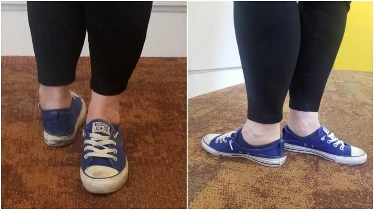 New Mexico woman's foot rotates 171.4 degrees