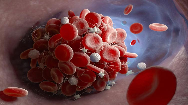 A safer blood thinner? This novel blood clot treatment doesn't increase bleeding risk