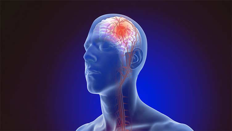 Early diagnosis, treatment key to curbing cognitive impairment after stroke