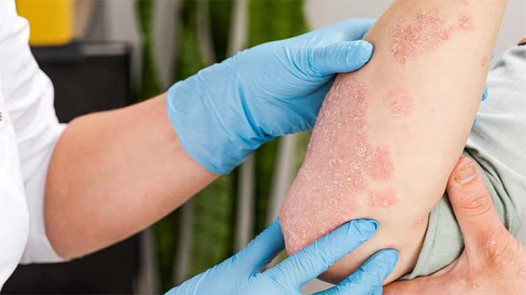Covid-19 and Psoriasis: Is there a link?