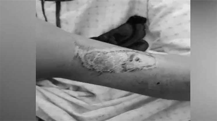 Police recover minor maid with torture and burns marks