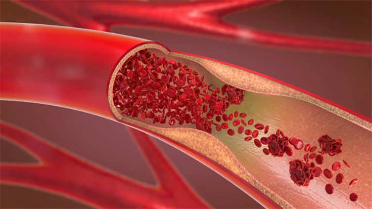 Older women may need better treatments for clogged arteries