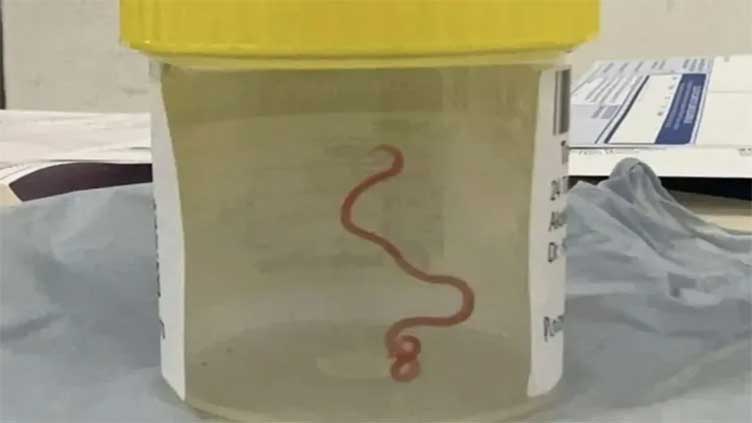 Doctors pull giant wriggling snake parasite out of woman's brain