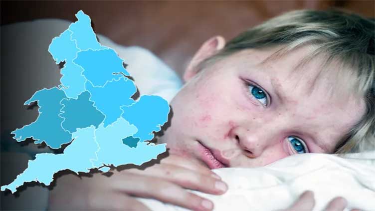 Measles kills 136,000 kids every year – would you recognise symptoms in your child before it's too late?