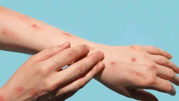 Authorities confirm chickenpox in over 40 schoolgirls in Upper Chitral 