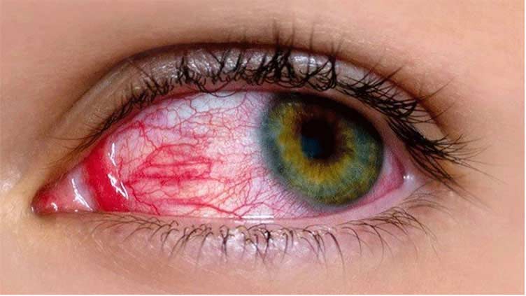 Surge in conjunctivitis as Punjab reports over 15,000 new cases during last 24 hours